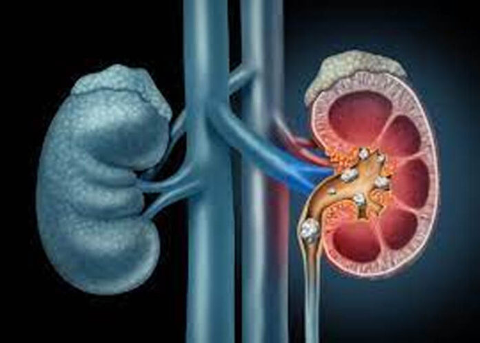 HEALTH | ಕಿಡ್ನಿ ಸ್ಟೋನ್ ಬಾರದಂತೆ ತಡೆಯೋಕೆ ಏನೆಲ್ಲಾ ಮಾಡಬಹುದು? ಇಲ್ಲಿದೆ ಉಪಯುಕ್ತ ಮಾಹಿತಿ..
