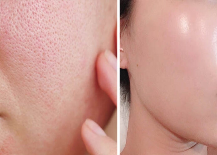 BEAUTY TIPS | ಮುಖದ ಮೇಲಿನ ಓಪನ್ ಪೋರ‍್ಸ್ ಅಂದಗೆಡಿಸುತ್ತಿದೆಯಾ? ಇದನ್ನು ದೂರ ಇಡೋಕೆ ಹೀಗೆ ಮಾಡಿ..